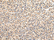 The image on the left is immunohistochemistry of paraffin-embedded Human prostate cancer tissue using CSB-PA101597(VAMP5 Antibody) at dilution 1/30, on the right is treated with fusion protein. (Original magnification: ×200)