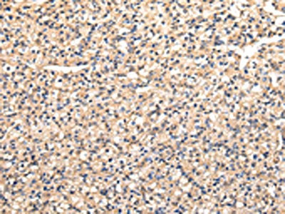 The image on the left is immunohistochemistry of paraffin-embedded Human prostate cancer tissue using CSB-PA101597(VAMP5 Antibody) at dilution 1/30, on the right is treated with fusion protein. (Original magnification: ×200)