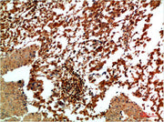 Immunohistochemical analysis of paraffin-embedded Human Lung Carcinoma Tissue using JNK2 Rabbit pAb diluted at 1:200