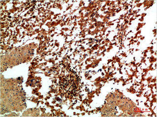 Immunohistochemical analysis of paraffin-embedded Human Lung Carcinoma Tissue using JNK2 Rabbit pAb diluted at 1:200