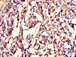 Immunohistochemistry of paraffin-embedded human gastric cancer using CSB-PA10169A0Rb at dilution of 1:100