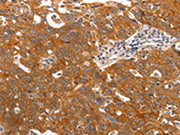 The image on the left is immunohistochemistry of paraffin-embedded Human ovarian cancer tissue using CSB-PA101729(PGC Antibody) at dilution 1/20, on the right is treated with fusion protein. (Original magnification: ×200)