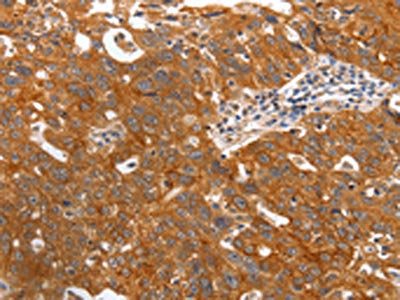 The image on the left is immunohistochemistry of paraffin-embedded Human ovarian cancer tissue using CSB-PA101729(PGC Antibody) at dilution 1/20, on the right is treated with fusion protein. (Original magnification: ×200)