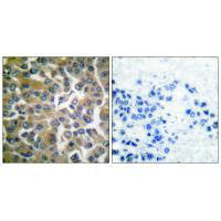 Immunohistochemical analysis of paraffin-embedded human breast carcinoma tissue using FAP-1 antibody.