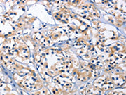 The image on the left is immunohistochemistry of paraffin-embedded Human thyroid cancer tissue using CSB-PA102123(CAPZA2 Antibody) at dilution 1/30, on the right is treated with fusion protein. (Original magnification: ×200)