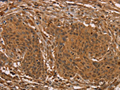 The image on the left is immunohistochemistry of paraffin-embedded Human cervical cancer tissue using CSB-PA102179(PRC1 Antibody) at dilution 1/25, on the right is treated with fusion protein. (Original magnification: ×200)