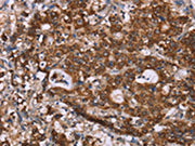 The image on the left is immunohistochemistry of paraffin-embedded Human gastic cancer tissue using CSB-PA102201(GAD1 Antibody) at dilution 1/40, on the right is treated with synthetic peptide. (Original magnification: ×200)