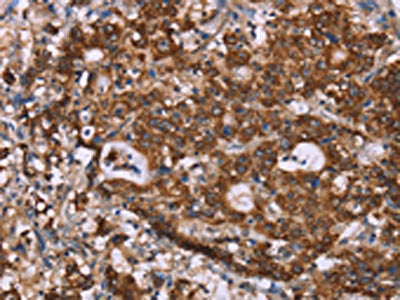 The image on the left is immunohistochemistry of paraffin-embedded Human gastic cancer tissue using CSB-PA102201(GAD1 Antibody) at dilution 1/40, on the right is treated with synthetic peptide. (Original magnification: ×200)