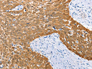 The image on the left is immunohistochemistry of paraffin-embedded Human cervical cancer tissue using CSB-PA102246(IRF6 Antibody) at dilution 1/50, on the right is treated with fusion protein. (Original magnification: ×200)