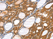 The image on the left is immunohistochemistry of paraffin-embedded Human thyroid cancer tissue using CSB-PA102253(SRGAP3 Antibody) at dilution 1/40, on the right is treated with fusion protein. (Original magnification: ×200)