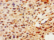 Immunohistochemistry of paraffin-embedded human glioma using CSB-PA10239A0Rb at dilution of 1:100