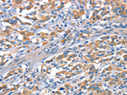 The image on the left is immunohistochemistry of paraffin-embedded Human thyroid cancer tissue using CSB-PA102499(CDH5 Antibody) at dilution 1/30, on the right is treated with synthetic peptide. (Original magnification: ×200)