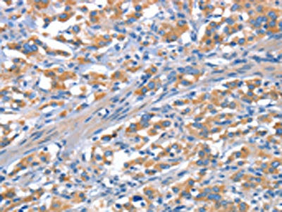The image on the left is immunohistochemistry of paraffin-embedded Human thyroid cancer tissue using CSB-PA102499(CDH5 Antibody) at dilution 1/30, on the right is treated with synthetic peptide. (Original magnification: ×200)