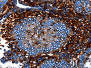 The image on the left is immunohistochemistry of paraffin-embedded Human cervical cancer tissue using CSB-PA102646(CNGA2 Antibody) at dilution 1/25, on the right is treated with fusion protein. (Original magnification: ×200)