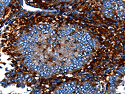 The image on the left is immunohistochemistry of paraffin-embedded Human cervical cancer tissue using CSB-PA102646(CNGA2 Antibody) at dilution 1/25, on the right is treated with fusion protein. (Original magnification: ×200)