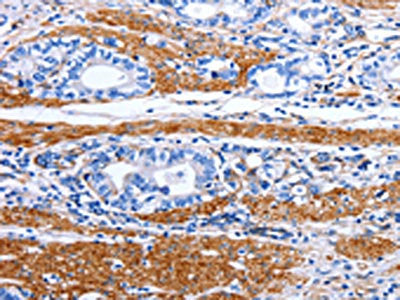 The image on the left is immunohistochemistry of paraffin-embedded Human stomach cancer tissue using CSB-PA102683(PRKAB1 Antibody) at dilution 1/15, on the right is treated with synthetic peptide. (Original magnification: ×200)