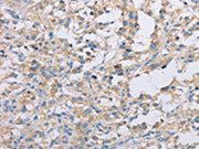 The image on the left is immunohistochemistry of paraffin-embedded Human thyroid cancer tissue using CSB-PA102745(ACTR2 Antibody) at dilution 1/30, on the right is treated with fusion protein. (Original magnification: ×200)