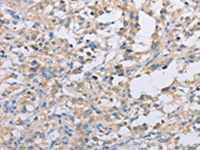 The image on the left is immunohistochemistry of paraffin-embedded Human thyroid cancer tissue using CSB-PA102745(ACTR2 Antibody) at dilution 1/30, on the right is treated with fusion protein. (Original magnification: ×200)