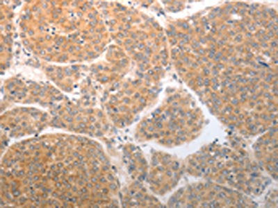 The image on the left is immunohistochemistry of paraffin-embedded Human liver cancer tissue using CSB-PA102829(NQO1 Antibody) at dilution 1/25, on the right is treated with synthetic peptide. (Original magnification: ×200)