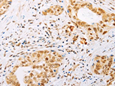 The image on the left is immunohistochemistry of paraffin-embedded Human cervical cancer tissue using CSB-PA102889(SPIN2B Antibody) at dilution 1/25, on the right is treated with fusion protein. (Original magnification: ×200)