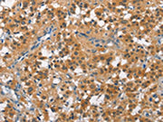 The image on the left is immunohistochemistry of paraffin-embedded Human thyroid cancer tissue using CSB-PA103046(CUL7 Antibody) at dilution 1/50, on the right is treated with fusion protein. (Original magnification: ×200)