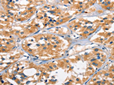 The image on the left is immunohistochemistry of paraffin-embedded Human thyroid cancer tissue using CSB-PA103047(AHR Antibody) at dilution 1/50, on the right is treated with synthetic peptide. (Original magnification: ×200)