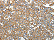 The image on the left is immunohistochemistry of paraffin-embedded Human breast cancer tissue using CSB-PA103174(GEMIN2 Antibody) at dilution 1/40, on the right is treated with synthetic peptide. (Original magnification: ×200)