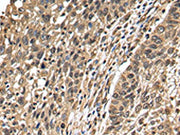 The image on the left is immunohistochemistry of paraffin-embedded Human lung cancer tissue using CSB-PA103304(TFDP2 Antibody) at dilution 1/25, on the right is treated with fusion protein. (Original magnification: ×200)