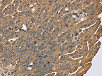 The image on the left is immunohistochemistry of paraffin-embedded Human breast cancer tissue using CSB-PA103365(ZMIZ1 Antibody) at dilution 1/40, on the right is treated with synthetic peptide. (Original magnification: ×200)