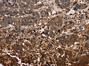 The image on the left is immunohistochemistry of paraffin-embedded Human liver cancer tissue using CSB-PA103410(FBP2 Antibody) at dilution 1/40, on the right is treated with fusion protein. (Original magnification: ×200)
