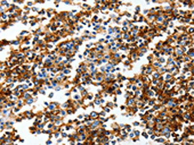 The image on the left is immunohistochemistry of paraffin-embedded Human tonsil tissue using CSB-PA103438(GRIA3 Antibody) at dilution 1/30, on the right is treated with synthetic peptide. (Original magnification: ×200)