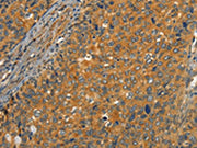 The image on the left is immunohistochemistry of paraffin-embedded Human cervical cancer tissue using CSB-PA103488(CIB1 Antibody) at dilution 1/30, on the right is treated with synthetic peptide. (Original magnification: ×200)