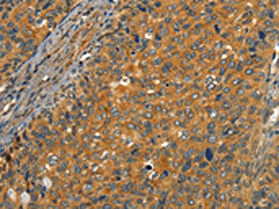 The image on the left is immunohistochemistry of paraffin-embedded Human cervical cancer tissue using CSB-PA103488(CIB1 Antibody) at dilution 1/30, on the right is treated with synthetic peptide. (Original magnification: ×200)