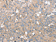 The image on the left is immunohistochemistry of paraffin-embedded Human breast cancer tissue using CSB-PA103501(STK36 Antibody) at dilution 1/20, on the right is treated with synthetic peptide. (Original magnification: ×200)