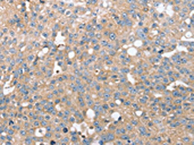 The image on the left is immunohistochemistry of paraffin-embedded Human breast cancer tissue using CSB-PA103501(STK36 Antibody) at dilution 1/20, on the right is treated with synthetic peptide. (Original magnification: ×200)