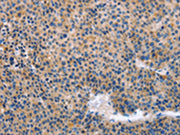 The image on the left is immunohistochemistry of paraffin-embedded Human liver cancer tissue using CSB-PA103566(KLF15 Antibody) at dilution 1/30, on the right is treated with fusion protein. (Original magnification: ×200)