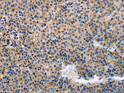 The image on the left is immunohistochemistry of paraffin-embedded Human liver cancer tissue using CSB-PA103566(KLF15 Antibody) at dilution 1/30, on the right is treated with fusion protein. (Original magnification: ×200)