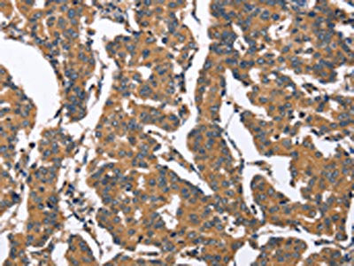 The image on the left is immunohistochemistry of paraffin-embedded Human breast cancer tissue using CSB-PA103726(BNIP2 Antibody) at dilution 1/50, on the right is treated with synthetic peptide. (Original magnification: ×200)