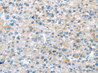 The image on the left is immunohistochemistry of paraffin-embedded Human liver cancer tissue using CSB-PA103770(TRIM47 Antibody) at dilution 1/20, on the right is treated with synthetic peptide. (Original magnification: ×200)