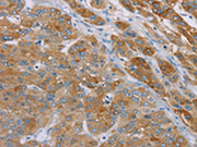 The image on the left is immunohistochemistry of paraffin-embedded Human liver cancer tissue using CSB-PA103967(SAMD4A Antibody) at dilution 1/30, on the right is treated with synthetic peptide. (Original magnification: ×200)