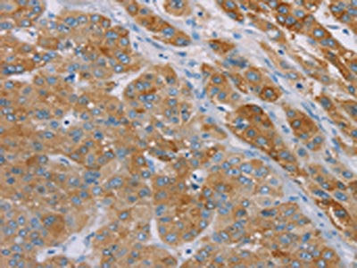 The image on the left is immunohistochemistry of paraffin-embedded Human liver cancer tissue using CSB-PA103967(SAMD4A Antibody) at dilution 1/30, on the right is treated with synthetic peptide. (Original magnification: ×200)
