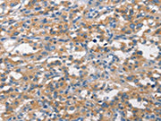 The image on the left is immunohistochemistry of paraffin-embedded Human thyroid cancer tissue using CSB-PA104246(ALCAM Antibody) at dilution 1/15, on the right is treated with synthetic peptide. (Original magnification: ×200)
