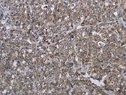 The image on the left is immunohistochemistry of paraffin-embedded Human ovarian cancer tissue using CSB-PA104319(MMP20 Antibody) at dilution 1/30, on the right is treated with synthetic peptide. (Original magnification: ×200)