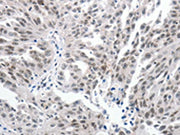 The image on the left is immunohistochemistry of paraffin-embedded Human ovarian cancer tissue using CSB-PA104347(PKD2 Antibody) at dilution 1/25, on the right is treated with synthetic peptide. (Original magnification: ×200)