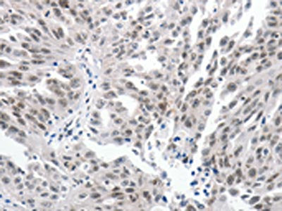 The image on the left is immunohistochemistry of paraffin-embedded Human ovarian cancer tissue using CSB-PA104347(PKD2 Antibody) at dilution 1/25, on the right is treated with synthetic peptide. (Original magnification: ×200)
