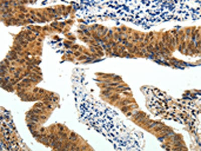 The image on the left is immunohistochemistry of paraffin-embedded Human colon cancer tissue using CSB-PA104445(PIWIL4 Antibody) at dilution 1/25, on the right is treated with fusion protein. (Original magnification: ×200)