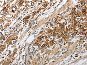 The image on the left is immunohistochemistry of paraffin-embedded Human gastic cancer tissue using CSB-PA104468(NPY1R Antibody) at dilution 1/30, on the right is treated with synthetic peptide. (Original magnification: ×200)