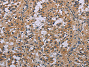The image on the left is immunohistochemistry of paraffin-embedded Human thyroid cancer tissue using CSB-PA104519(ACVR2A Antibody) at dilution 1/20, on the right is treated with synthetic peptide. (Original magnification: ×200)