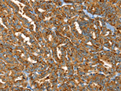 The image on the left is immunohistochemistry of paraffin-embedded Human thyroid cancer tissue using CSB-PA104597(PTPN3 Antibody) at dilution 1/30, on the right is treated with fusion protein. (Original magnification: ×200)