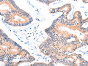 The image on the left is immunohistochemistry of paraffin-embedded Human colon cancer tissue using CSB-PA104599(AOC1 Antibody) at dilution 1/15, on the right is treated with fusion protein. (Original magnification: ×200)